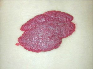 写真4：苺状血管腫