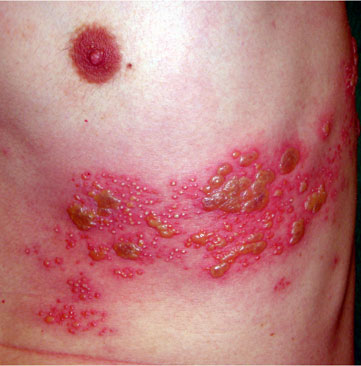 痛み 帯状 いつまで 疱疹 早めに対処 帯状疱疹（ほうしん）の症状チェック・治療のポイント