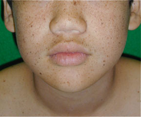 顔だけ 紫外線アレルギー 紫外線アレルギーの症状とは？顔のかゆみの原因。対策と治療法