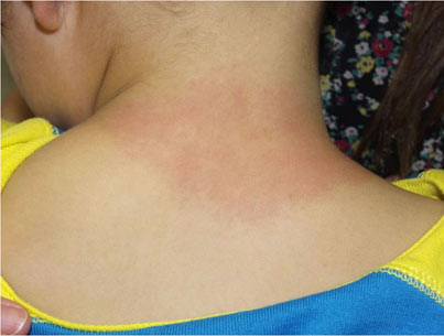 赤い 斑点 日焼け 日光皮膚炎とは？症状・原因・治療・病院の診療科目