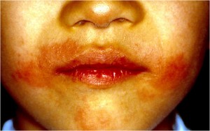 マンゴによるアレルギー性接触皮膚炎
